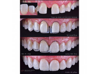 Diastema closure with teeth composite in kampala