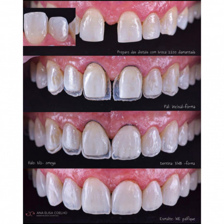 diastema-closure-with-teeth-composite-in-kampala-big-0