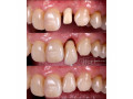 teeth-dental-crowning-in-kampala-small-0